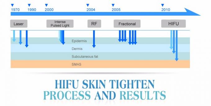 2016 máquina médica do hifu do tratamento facial da remoção do enrugamento do cuidado SMAS